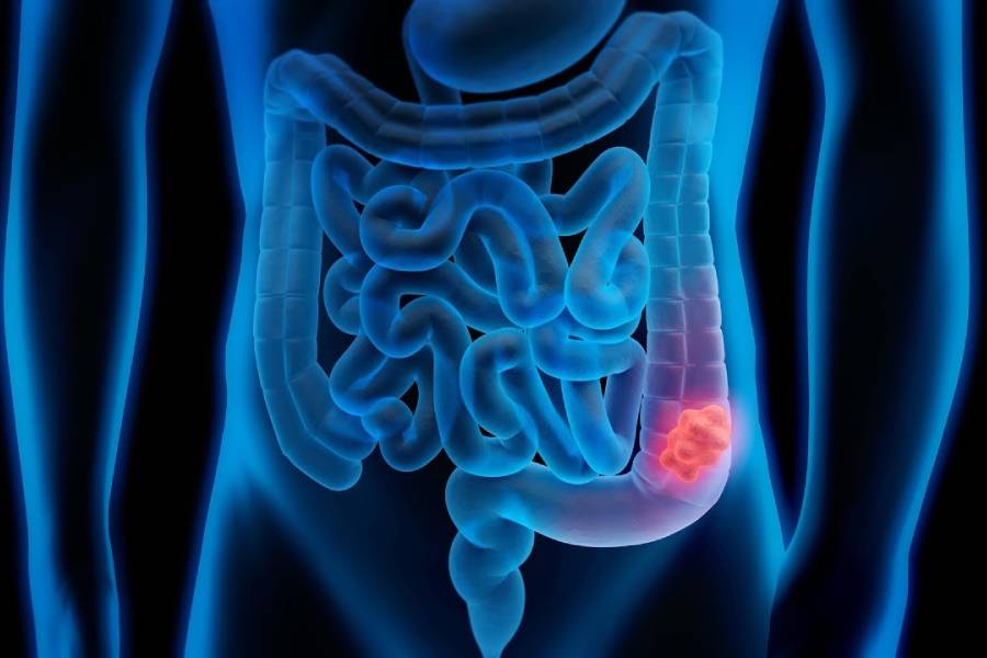 Gastro-Intestinal Malignancy