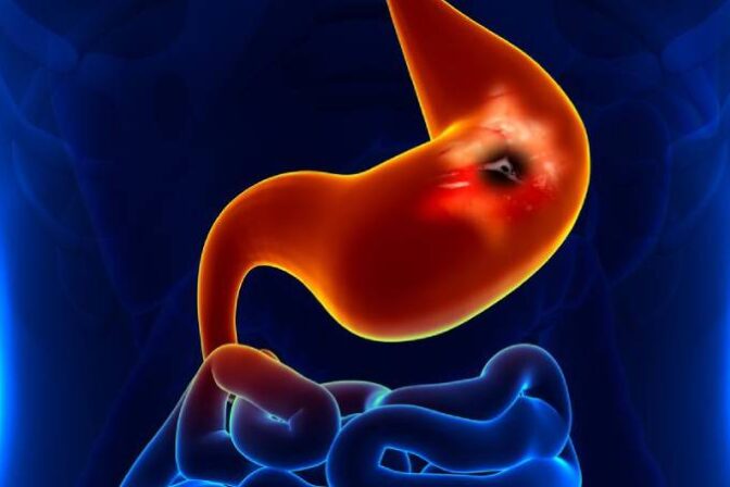 Awareness of Risk Factors is Key to Preventing Stomach Cancer