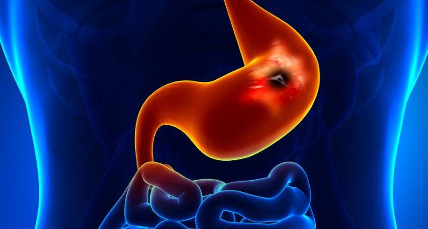 Awareness of Risk Factors is Key to Preventing Stomach Cancer