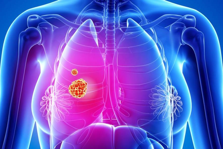 Thoracic Oncology