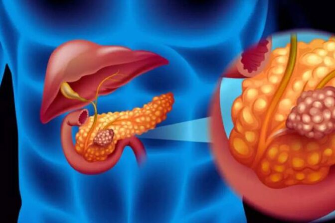Pancreatic Cancer Treatment in Pune - Dr Lalit Banswal