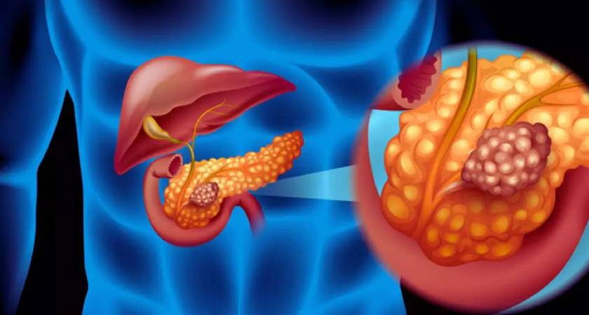 Pancreatic Cancer Treatment in Pune - Dr Lalit Banswal