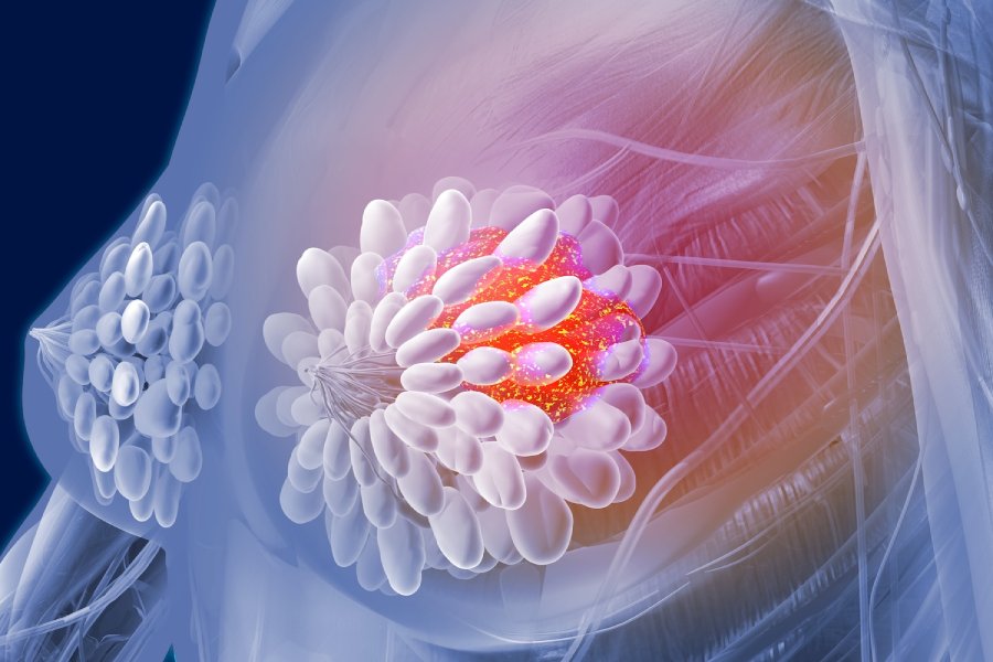 3D illustration of breast anatomy highlighting a tumor, representing breast cancer treatment by a specialist in Pune