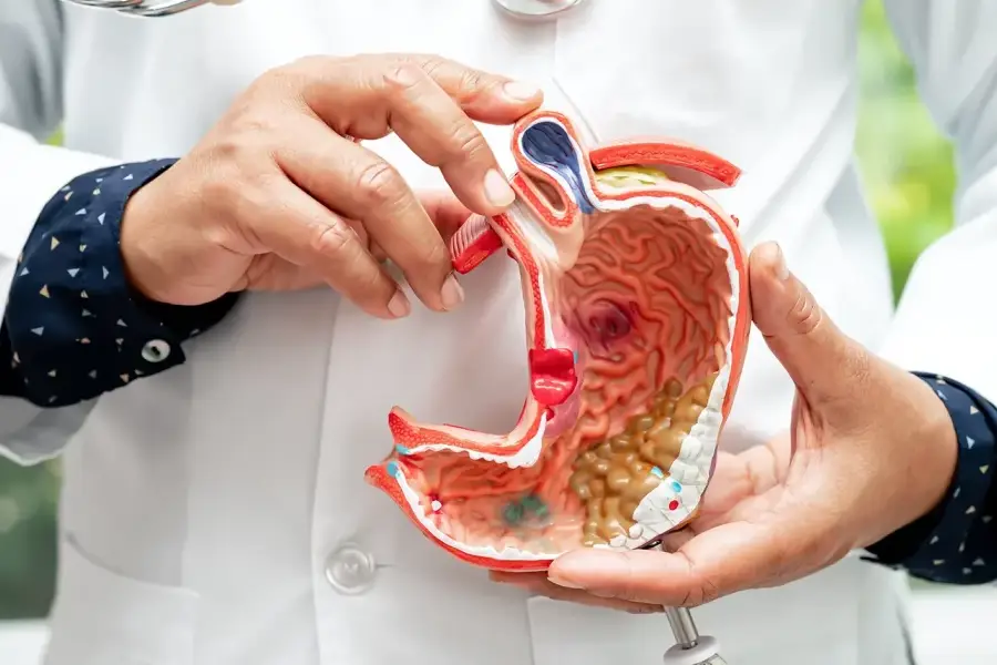 Doctor showing anatomical model of human stomach with gastric cancer