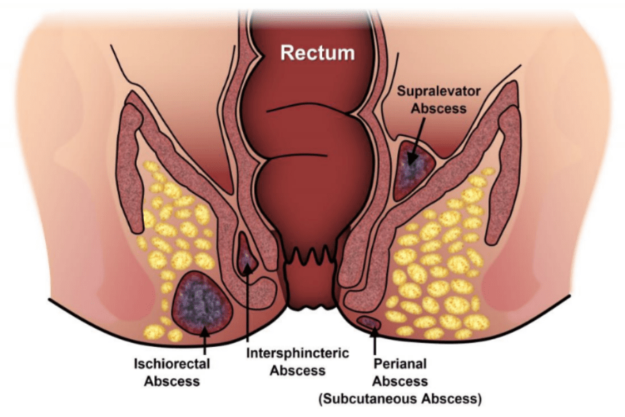 Types of anal abscesses involved in fistula – Fistula Treatment in Pune