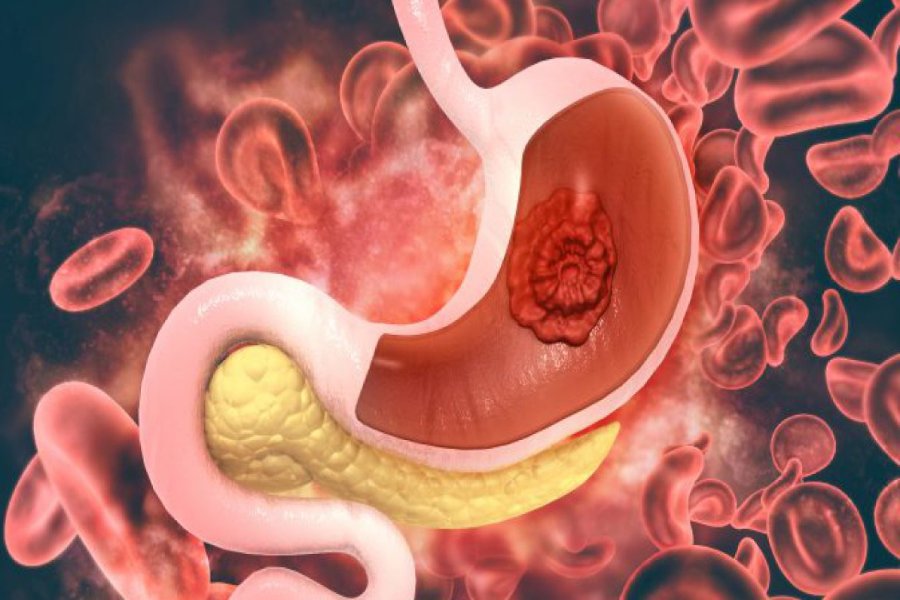 Cross-sectional illustration of stomach showing gastrointestinal cancer tumor - GI Cancer Treatment in Pune