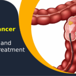 Illustration showing rectal cancer diagnosis and tumor location in the colon