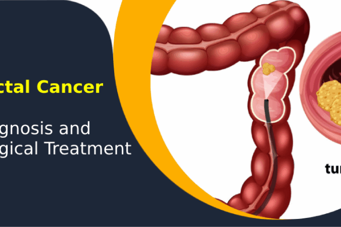 Illustration showing rectal cancer diagnosis and tumor location in the colon