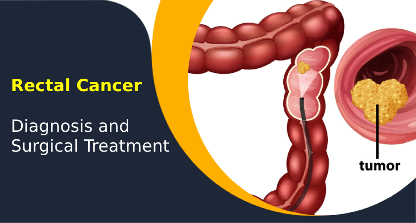 Illustration showing rectal cancer diagnosis and tumor location in the colon