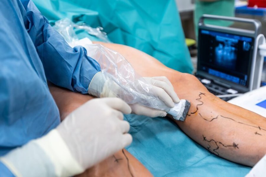 Minimally invasive varicose veins treatment in Pune using ultrasound-guided laser therapy