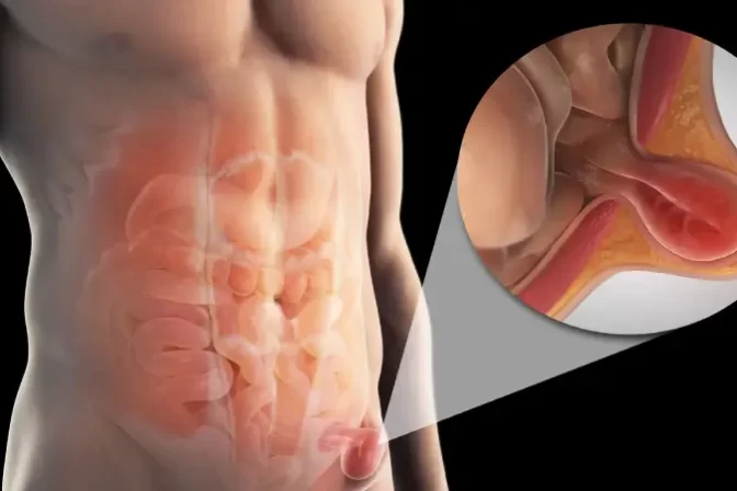 हर्नियाचे उपचार न केल्यास काय होऊ शकते याचे शरीरातील दृश्य