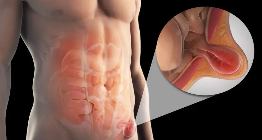 हर्नियाचे उपचार न केल्यास काय होऊ शकते याचे शरीरातील दृश्य