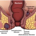 फिस्टुला शस्त्रक्रियेनंतर परत होऊ शकतो का