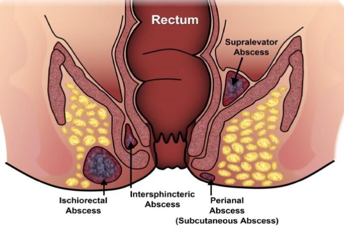 फिस्टुला शस्त्रक्रियेनंतर परत होऊ शकतो का