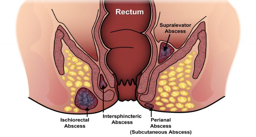 फिस्टुला शस्त्रक्रियेनंतर परत होऊ शकतो का