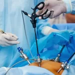Surgeons performing laparoscopic surgery using advanced instruments, showing the possible risks and complications of laparoscopic surgery.