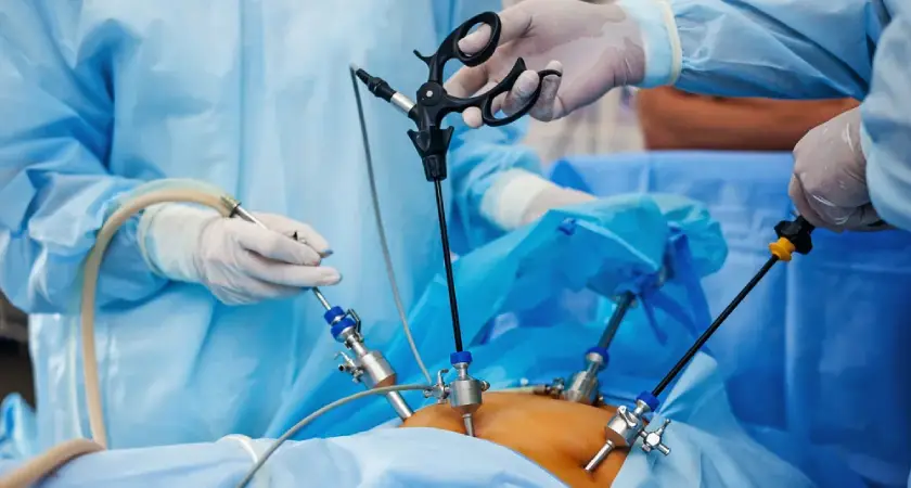 Surgeons performing laparoscopic surgery using advanced instruments, showing the possible risks and complications of laparoscopic surgery.