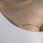 Lumpectomy vs Mastectomy – Understanding the Right Surgery Option for Breast Cancer Treatment