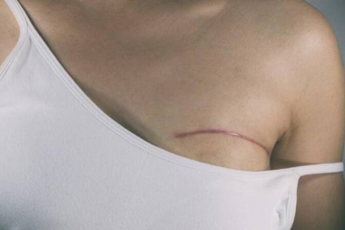 Lumpectomy vs Mastectomy – Understanding the Right Surgery Option for Breast Cancer Treatment