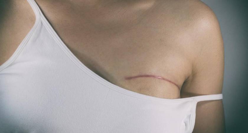 Lumpectomy vs Mastectomy – Understanding the Right Surgery Option for Breast Cancer Treatment