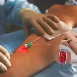 Laser treatment for varicose veins procedure on leg performed by Dr. Lalit Banswal in Pune