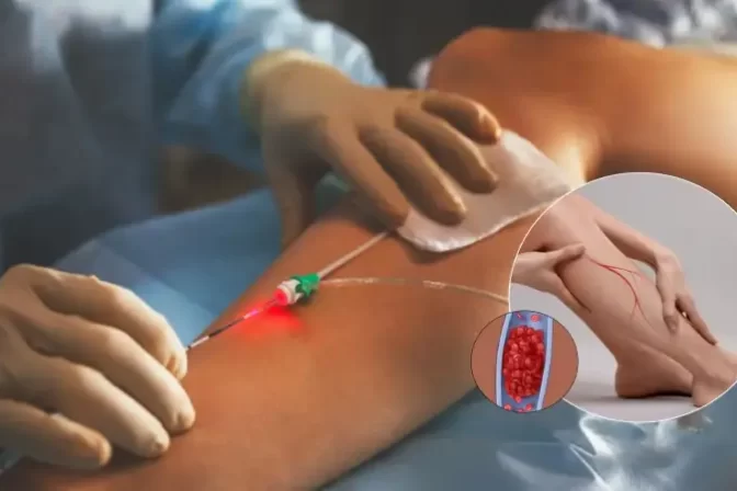 Laser treatment for varicose veins procedure on leg performed by Dr. Lalit Banswal in Pune