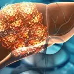 Illustration showing tumour growth inside the liver highlighting the early signs of liver cancer.