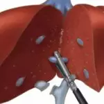 Partial Hepatectomy surgery showing removal of the cancerous part of the liver