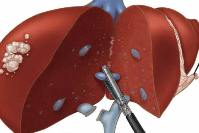 Partial Hepatectomy surgery showing removal of the cancerous part of the liver