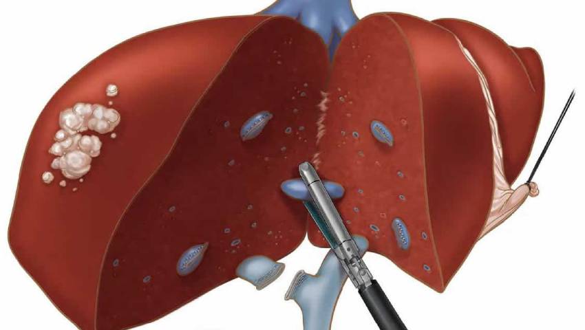 Partial Hepatectomy surgery showing removal of the cancerous part of the liver