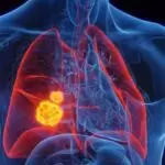 Illustration showing lung tumors inside the chest, explaining when does lung cancer surgery become necessary for treatment.