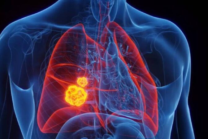 Illustration showing lung tumors inside the chest, explaining when does lung cancer surgery become necessary for treatment.
