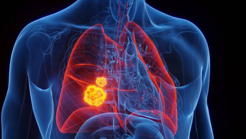 Illustration showing lung tumors inside the chest, explaining when does lung cancer surgery become necessary for treatment.