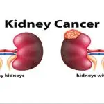 Illustration comparing healthy kidneys with kidneys with tumors to explain different types of kidney cancer surgeries and the operation of kidney removal.