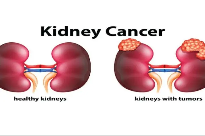 Illustration comparing healthy kidneys with kidneys with tumors to explain different types of kidney cancer surgeries and the operation of kidney removal.