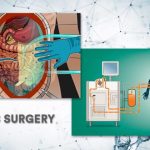 A medical illustration explaining what is HIPEC surgery, showing the heated chemotherapy delivery process used in hipec surgery ovarian cancer and abdominal treatments, while considering the complexity and hipec surgery duration for a complete hipec surgery meaning.