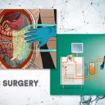 A medical illustration explaining what is HIPEC surgery, showing the heated chemotherapy delivery process used in hipec surgery ovarian cancer and abdominal treatments, while considering the complexity and hipec surgery duration for a complete hipec surgery meaning.