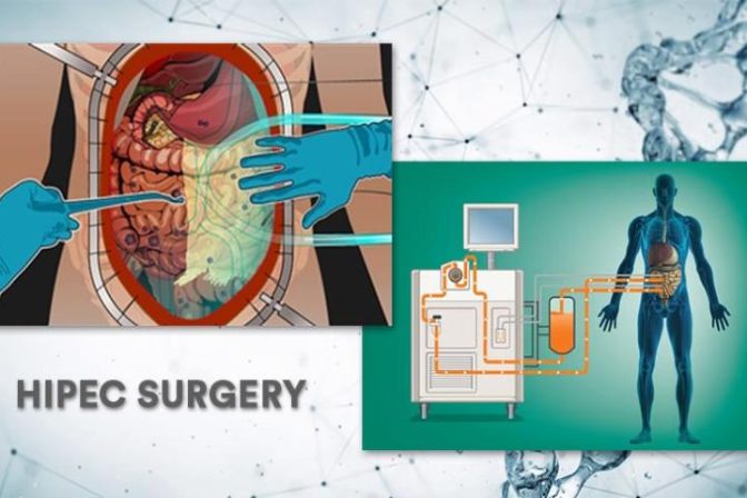 A medical illustration explaining what is HIPEC surgery, showing the heated chemotherapy delivery process used in hipec surgery ovarian cancer and abdominal treatments, while considering the complexity and hipec surgery duration for a complete hipec surgery meaning.