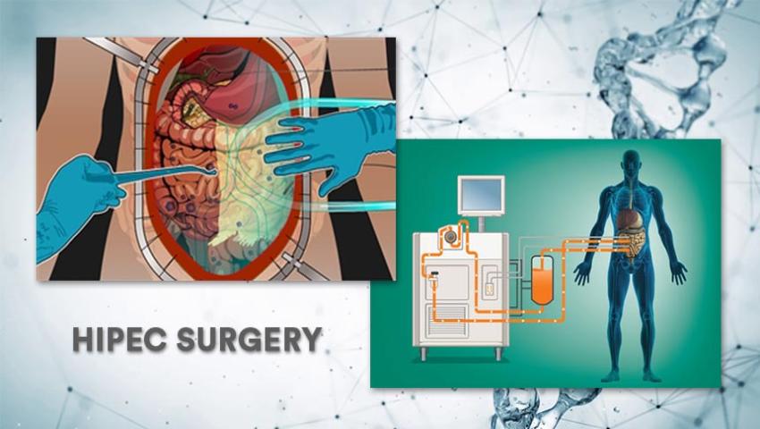 A medical illustration explaining what is HIPEC surgery, showing the heated chemotherapy delivery process used in hipec surgery ovarian cancer and abdominal treatments, while considering the complexity and hipec surgery duration for a complete hipec surgery meaning.