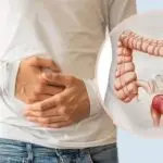 A medical diagram showing an intestine operation for Rectal Cancer, explaining the colectomy meaning through a visual of a hemicolectomy procedure to remove cancerous tissues.