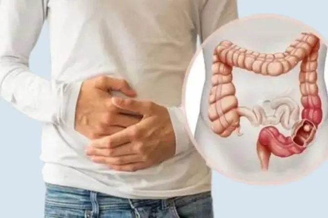 A medical diagram showing an intestine operation for Rectal Cancer, explaining the colectomy meaning through a visual of a hemicolectomy procedure to remove cancerous tissues.
