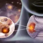 An informative medical illustration explaining what is thyroidectomy and the common thyroidectomy causes, showing the precise steps of a thyroidectomy operation and general thyroid surgery techniques.