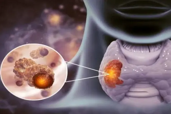 An informative medical illustration explaining what is thyroidectomy and the common thyroidectomy causes, showing the precise steps of a thyroidectomy operation and general thyroid surgery techniques.