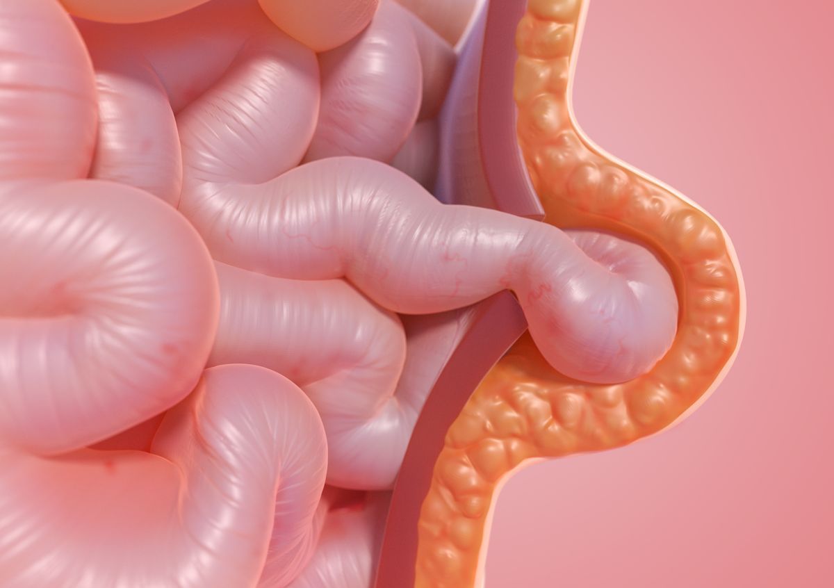 Umbilical Hernia